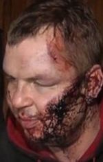 Дмитрия Булатова прооперировали