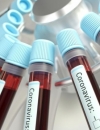 За сутки зафиксировали 29 новых случаев коронавируса - всего 113